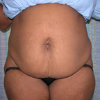 Tummy Tuck Orange County, CA - Plastic / Cosmetic Surgeon Dr. Bui