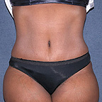 Tummy Tuck Anaheim, CA - Plastic / Cosmetic Surgeon Dr. Bui