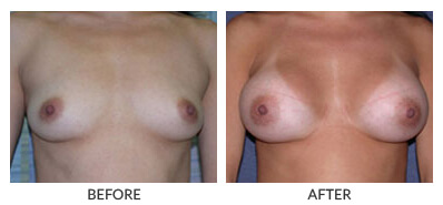 Visit Our Breast Augmentation Gallery