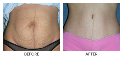 Visit Our Tummy Tuck Gallery