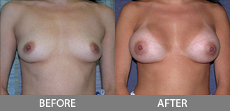 Before and After Breast Augmentation - Orange County, CA