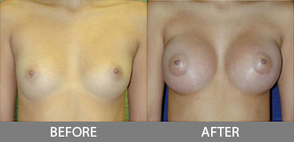 Before and After Breast Augmentation - Orange County, CA