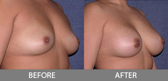 Before and After Breast Augmentation - Orange County, CA