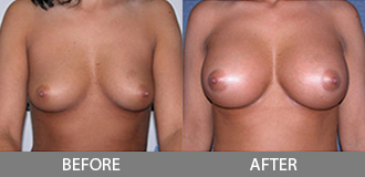 Before and After Breast Augmentation - Orange County, CA