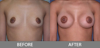 Before and After Breast Augmentation - Orange County, CA