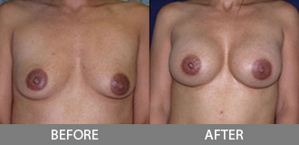 Before and After Breast Augmentation - Orange County, CA