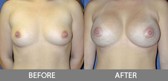 Before and After Breast Augmentation - Orange County, CA