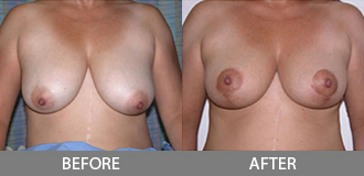 Before and After Breast Lift - Orange County, CA