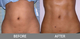 Before and After Liposuction - Orange County, CA