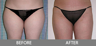 Before and After Liposuction - Orange County, CA