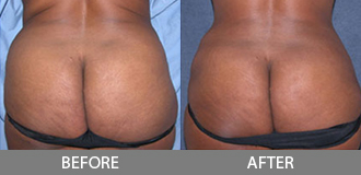 Before and After Liposuction - Orange County, CA
