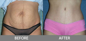 Tummy Tuck Gallery