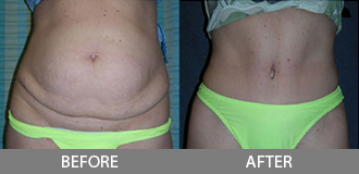 Before and After Tummy Tuck - Orange County, CA