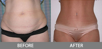 Before and After Tummy Tuck - Orange County, CA