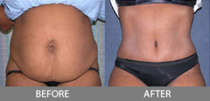 Tummy Tuck Gallery