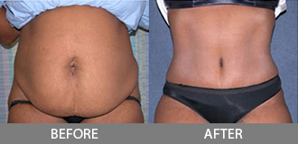 Before and After Tummy Tuck - Orange County, CA