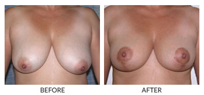 Visit Our Breast Lift Gallery