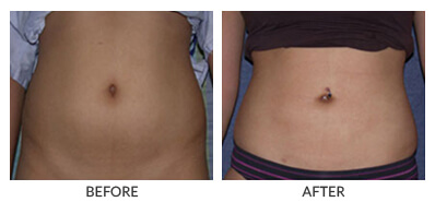 Visit Our Liposuction Gallery