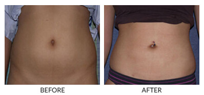 Abs/Flanks - KleinLipo - Liposuction Surgery of Orange County